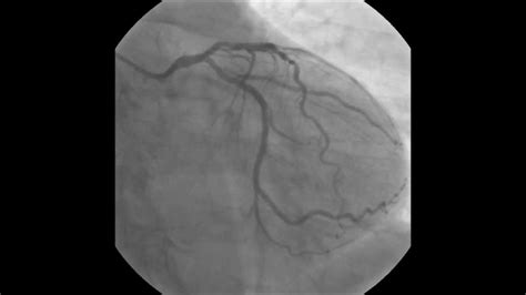 Pci Rca Direct Stenting With Nobori Stent Youtube