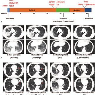 A Schematics Showing The Treatment History Of The Patient B Chest