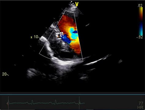 Follow Up Echocardiography After Device Deployment Download