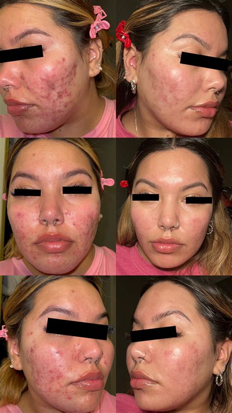 4 Months On Tret Before And After R Tretinoin