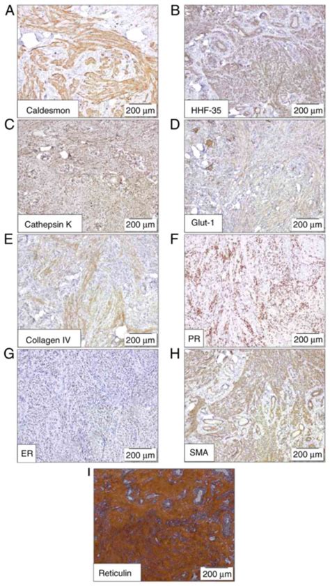 Myopericytomamyofibroma As A Stromal Component Of Mixed Epithelial And