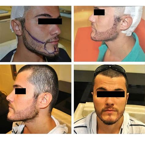 Beard Transplant In Istanbul Turkey Best Clinics Surgeons And Costs