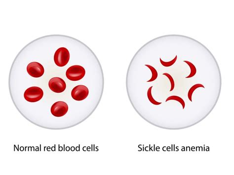 Sickle Cell Anemia Symptoms Treatment Options Causes And More