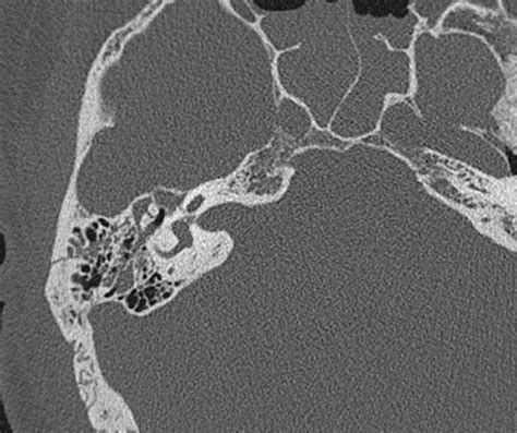 [figure Right Temporal Bone Fracture Computed ] Statpearls Ncbi