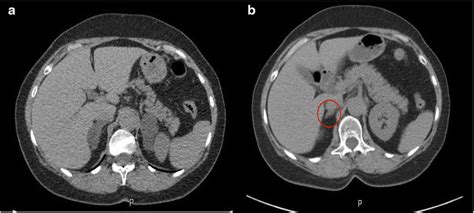 Adrenal Ct Of Patient With Symmetric Bilateral Hyperplasia A Download Scientific Diagram