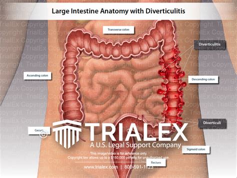 Large Intestine Anatomy With Diverticulitis Trialexhibits Inc