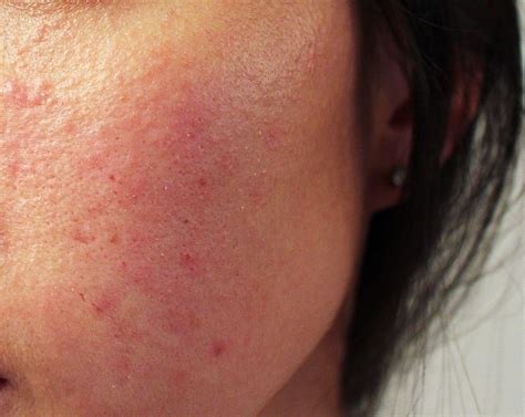 Allergic Reaction To Makeup Rash - Mugeek Vidalondon