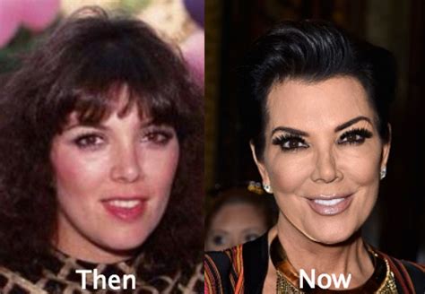 Kris Jenner Plastic Surgery on Hand Before and After