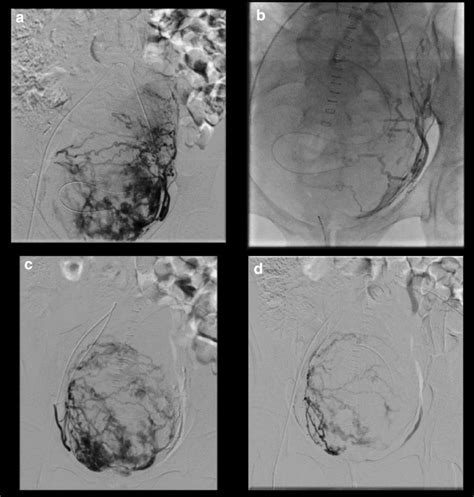 Pictures Of The Uterine Arterial Embolization A C Post Embolization