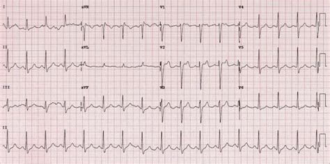 Preexcitation Syndromes Litfl Ecg Library Diagnosis