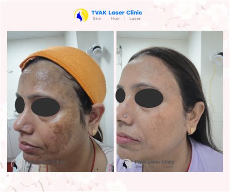 Birthmark Removal – Tvak Laser Clinic