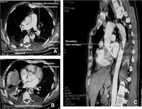 Ct Angiography Showing A Thrombus In The Pulmonary Artery Branches Download Scientific Diagram