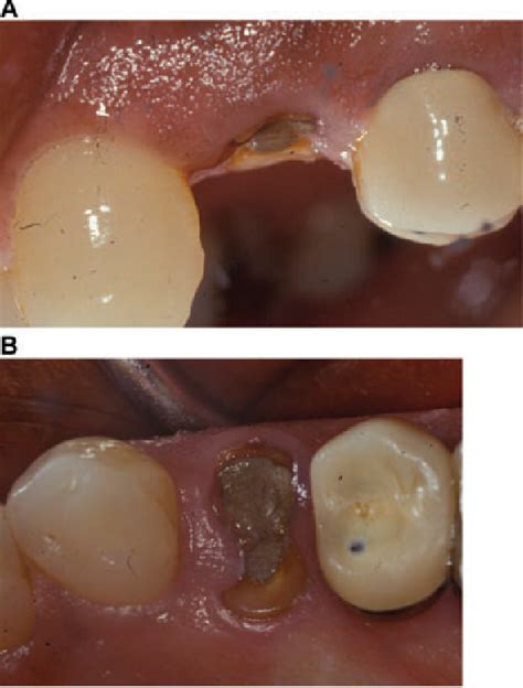 Figure From Immediate Implant Placement Clinical Decisions