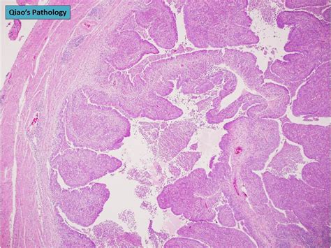 Qiao S Pathology Acute Salpingitis Microscopic Photo Show Flickr