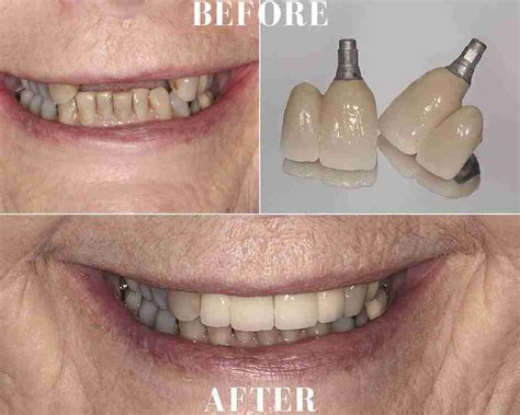 Implant Crowns In Front Teeth Ocean Breeze Prosthodontist