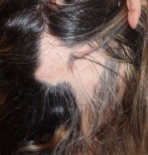 Alopecia Areata Solución causas problema tratamiento especialista