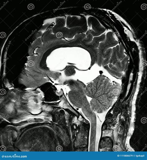 Brain Pathology Pineal Cyst Mri Exam Stock Illustration Illustration