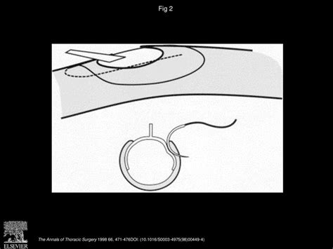 Temporary Luminal Arteriotomy Seal Ii Ppt Download