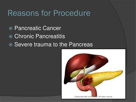 Ppt Pa N Creaticoduodenectomy The Whipple Procedure Powerpoint