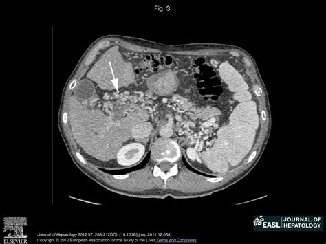 Portal Vein Thrombosis Cirrhosis And Liver Transplantation Ppt Download