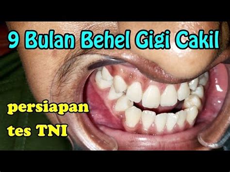 9 Bulan Persiapan Tes TNI Perawatan Behel Gigi Cakil Dokter Gigi Jogja