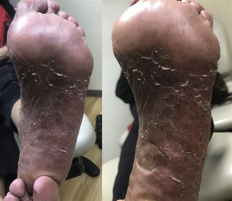 Successful Treatment Of Palmoplantar Psoriasis With Chemical Peeling