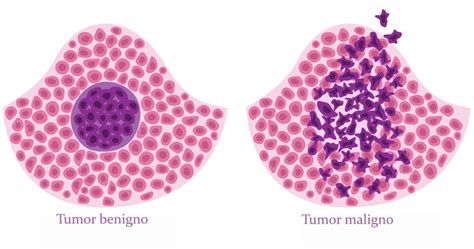 H Liga O Entre Tumor Benigno E Hematol Gico Revista Online Abrale