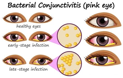 Bacterial Conjunctivitis Pink Eye