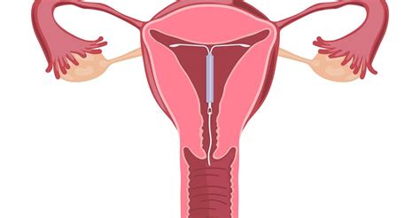 Womans Iud Was In Her Abdomen For Years