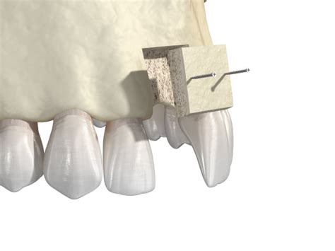 What Is Bone Grafting Bryn Mawr Pa Dental Bone Graft Options