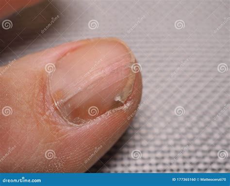 Nail Infections Caused By Fungi Such As Onychomycosis Caused By