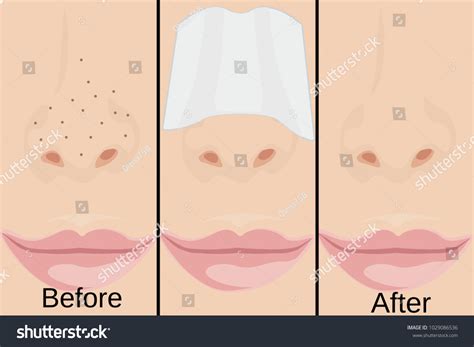 Blackheads On Nose Vector Illustration Showing Stock Vector (Royalty Free) 1029086536