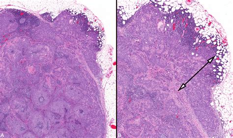 A Low Power Image Of A Lymph Node Containing Metastatic Squamous Cell Download Scientific