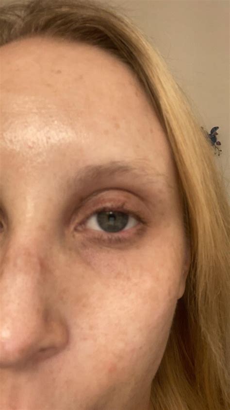 Eyelids Beginning To Droop Only 29 Rskincareaddicts