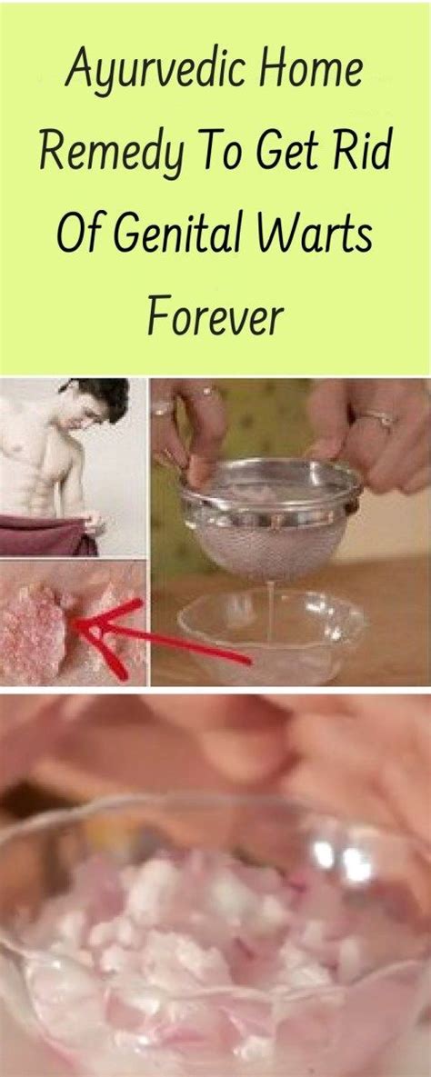 Ayurvedic Home Remedy To Get Rid Of Genital Warts Forever Sağlık