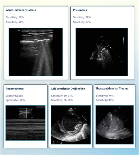 Point Of Care Ultrasonography NEJM