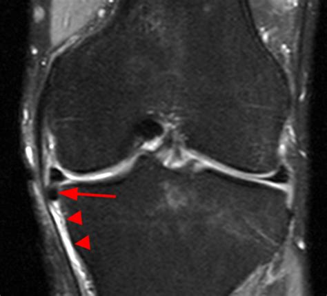 Horizontal Meniscal Tear Mri