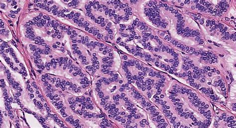 Pathology Outlines Well Differentiated Neuroendocrine Tumor