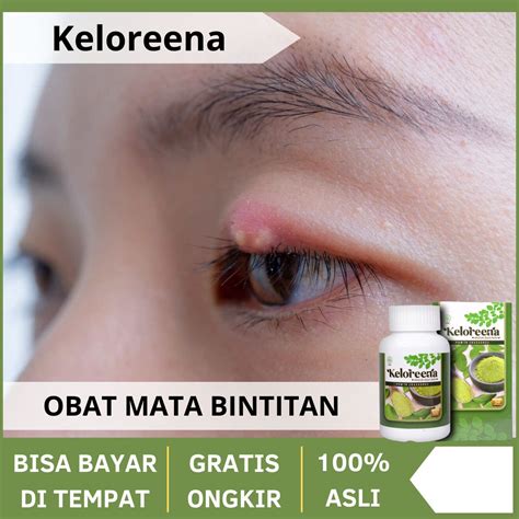 Obat Mata Bintitan Kalazion Penghilang Benjolan Bintit Bernanah