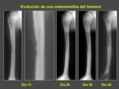 1 Osteomielitis Agudas Upap