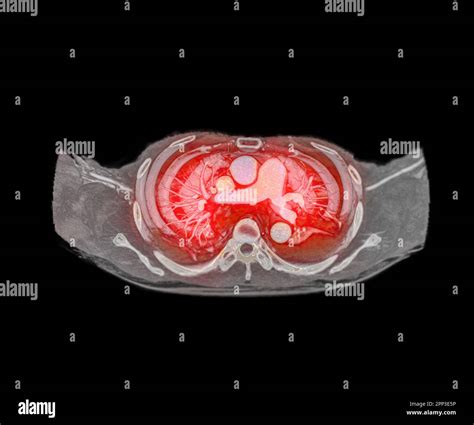 Cta Pulmonary Arteries D Rendering Showing Branch Of Pulmonary Artery