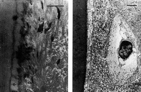 Low Power Electron Micrograph Of The Tissue Adjacent To A Steel