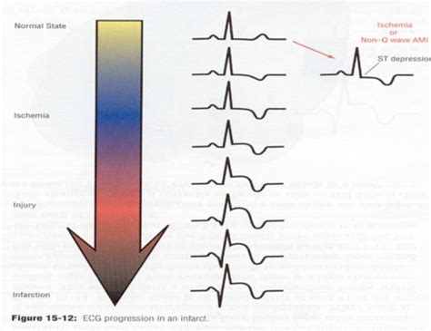 EKG Ischemia And Infarct Diagnostics Exam 1 Flashcards Quizlet