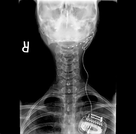 Occipital Nerve Mri