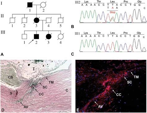 Patient Pedigree Mutation Screening And Fibrillin 1 Expression In The Download Scientific