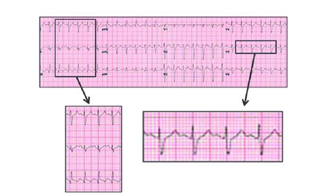 Diagnóstico diferencial electrocardiográfico de la taquicardia de