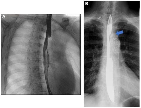 Surgical Repair Of Severe Dysphagia Lusoria Journal Of Vascular