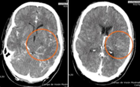 Isquemia Cerebral Como Complicaci N Intraoperatoria Por Posicionamiento