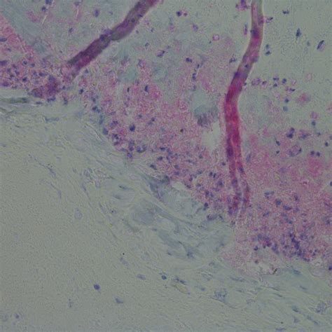 (A) Skin lesions on the hand of a Morgellons disease patient. (B) Skin... | Download Scientific ...