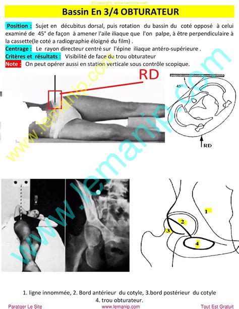 Incidences Radiologiques Du Bassin et L Hanche Coxométrie